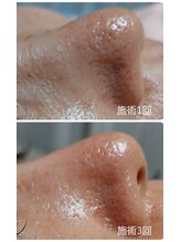 ビアンカーラ(Biancara)/浮き出る【韓国式3D毛穴洗浄】