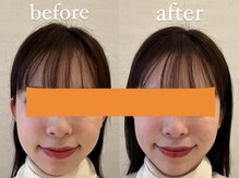 ハリノヒ 大阪院/美容鍼でむくみ・たるみ改善事例