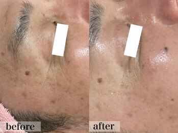 エステサロン ジョアアンジェ(joie ange)/シルク 1回