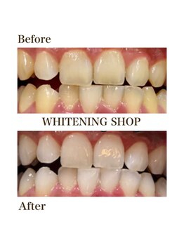 ホワイトニングショップ 阪急伊丹店/ビフォーアフター
