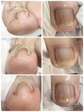 リゼラアンドコー 布施店/ヘイスイッチ巻き爪ケア！