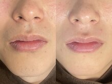 アルム(a'lm)/メンズヒゲワックス脱毛/顔脱毛