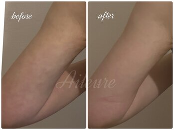 エルール トータルビューティ(Aileure total beauty)/ダウンタイム二の腕　インディバ