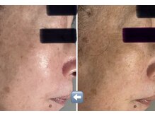 チェスタ/70代　肌変化