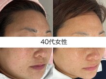 シミケア専門店 SAKURA 平塚店/平塚シミケア/伊勢店シミケア