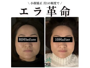キュープ 高崎店(Qpu)の写真/【小顔矯正+美肌美顔器4回モニターコース】通常￥39600がモニター￥22000に！よりお得に小顔ケア♪