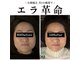 キュープ 高崎店(Qpu)の写真/【小顔矯正+美肌美顔器4回モニターコース】通常￥39600がモニター￥22000に！よりお得に小顔ケア♪