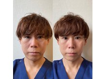 アキュティ 吉祥寺(Acuty)の雰囲気(セルフケア美容鍼【ビフォー&アフター】施術直後♪)