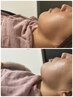 【業界初!縦横シワアプローチ】ラミネーションピール+生パック★剥離なし