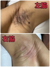 ミロクビューティーガーデン(MirokuBG)/脇WAX脱毛