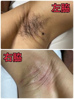 ミロクビューティーガーデン(MirokuBG)/脇WAX脱毛