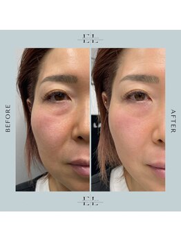 ミルメ(MIRUME)/エクソリフト