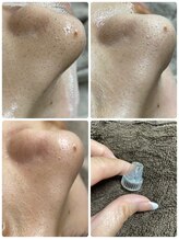 美肌脱毛専門店 パールプラス 大在店/毛穴洗浄