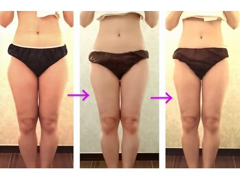 バービーホリック(barbie holic)/痩身　途中経過の変化 　２０代