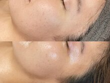 ビジュープラス 広島店(Bijou+)/【20代/ニキビケア、くすみ】