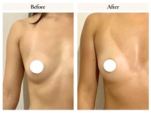 サロンドローヴ(Salon de LOAVE)/バストアップ症例