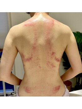 ビレイ(Birei)/カッサ