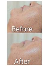 ミヨン ヨコハマ(Miyonne Yokohama)/LDM Aqua＋小顔ヘッドスパ上大岡