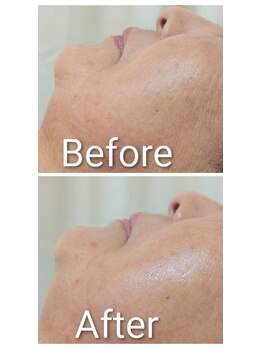 ミヨン ヨコハマ(Miyonne Yokohama)/LDM Aqua+小顔ヘッドスパ上大岡