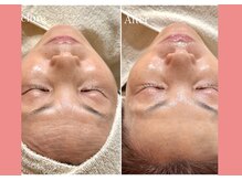 くすみ・たるみ・毛穴・小顔など加齢と共に出てくる悩みを解決♪