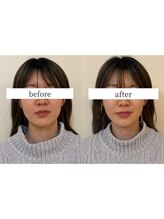 ヘルシールーム 六本木7丁目店(Healthy room)/before/after【左右差/小顔】