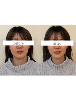 ヘルシールーム 六本木7丁目店(Healthy room)/before/after【左右差/小顔】