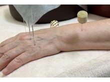 命水鍼灸院/手首【新宿/鍼灸】