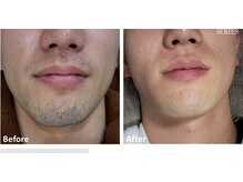 ララリア(LaLaLia)/ひげ　ビフォーアフター