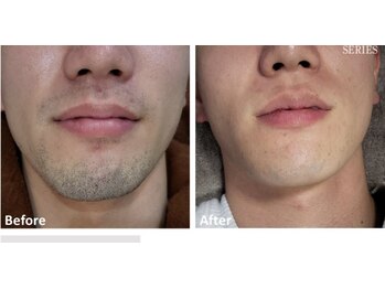 ララリア(LaLaLia)/ひげ　ビフォーアフター