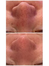 ヘアメイク エステサロン クラシカ(hairmake esthe salon clasika)/ハイドロフェイシャル