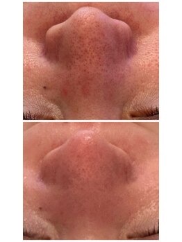 ヘアメイク エステサロン クラシカ(hairmake esthe salon clasika)/ハイドロフェイシャル