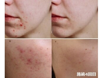 ナチュレアンドメディカ(Nature&Medica)/顔脱毛+ニキビケアフェイシャル
