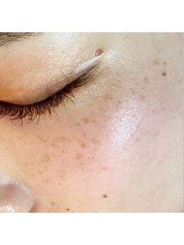 シミしわ改善！予防ケア