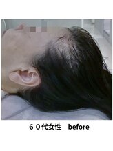 イーズ/リバイタ 梅田本店/【ケース4】６０代女性　before