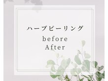 ココ 2号店(CoCo)/ハーブピーリング/肌質を改善