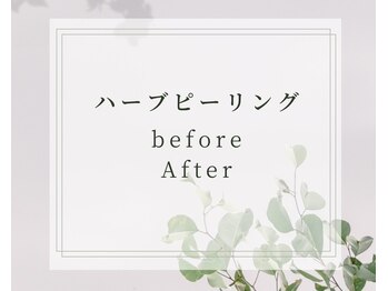 ココ 2号店(CoCo)/ハーブピーリング/肌質を改善