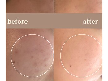 ユーアンドハニー(U&Honey.)/ニキビケアで素肌美人！