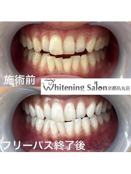 ホワイトニングサロン 京都烏丸店/ホワイトニング施術例