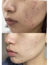 ビーメイクス(B・Makes)/プラズマフェイシャル