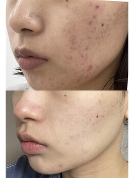 ビーメイクス(B・Makes)/プラズマフェイシャル