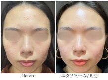 ビボーラ(BEBEAURA)/☆エクソソームフェイシャル☆