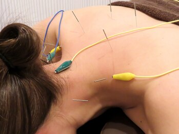 ティンクル(Twinkle)/もみほぐし＋鍼