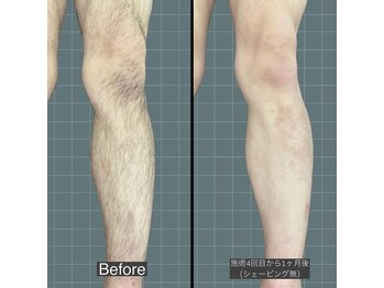 アレッド 大阪店(ared.)/冬にやるべき！足脱毛