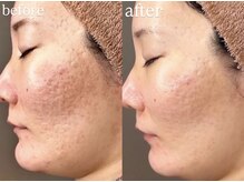 ホワイトアクア 明石店(WHITE AQUA)/ハーブピーリング/ニキビケア