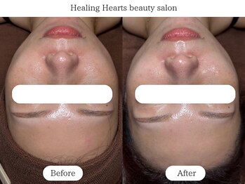 ヒーリングハーツ(Healing Hearts)/小顔・毛穴・肌荒れ改善始動!