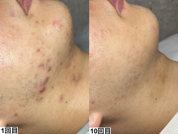 アンドミー 中百舌鳥(&me)/ハーブピーリング【ニキビケア】