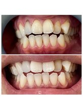 ウルト(ULT)/セルフホワイトニング