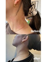 エクラ(ECLAT)/インナーケア商品で肌荒れ改善！