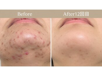 アルト(ALTO)の写真/ダウンタイム少ないニキビ凹凸ケアハーブピーリングで艶肌へ！高級ハーブ仕様の贅沢ケア♪