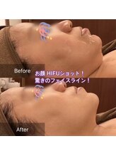 山王スパ/顔ウルトラVリフト施術イメージ